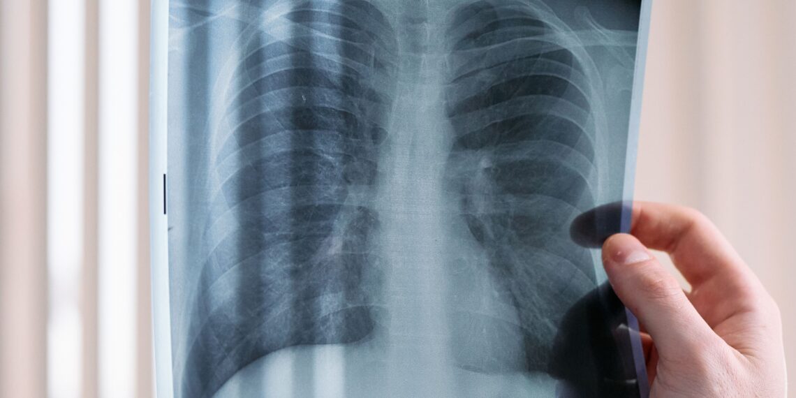 Kemenkes atau Kementerian Kesehatan RI memperluas upaya penemuan kasus tuberkulosis (TB) secara aktif melalui skrining menggunakan rontgen dada berbasis Artificial Intelligence (AI) di pondok pesantren dan pemukiman padat penduduk.(Foto: Ilustrasi/pexels)
