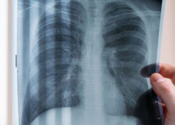 Kemenkes atau Kementerian Kesehatan RI memperluas upaya penemuan kasus tuberkulosis (TB) secara aktif melalui skrining menggunakan rontgen dada berbasis Artificial Intelligence (AI) di pondok pesantren dan pemukiman padat penduduk.(Foto: Ilustrasi/pexels)